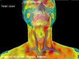 thyroid color